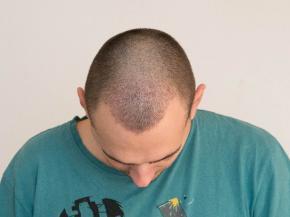 Przeszczepy włosów Warszawa po zabiegu transplantacji włosów