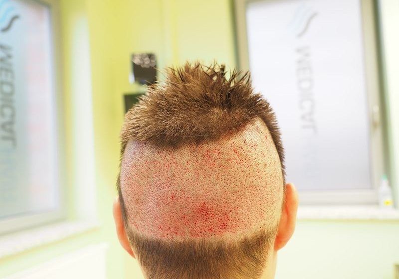 Głowa w trakcie przeszczepu włosów z wykorzystaniem metody FUE