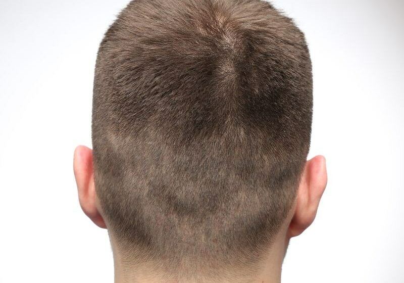 Przeszczep włosów metodą FUE w Medical Hair